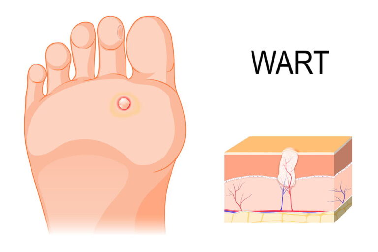 What helps against plantar warts?