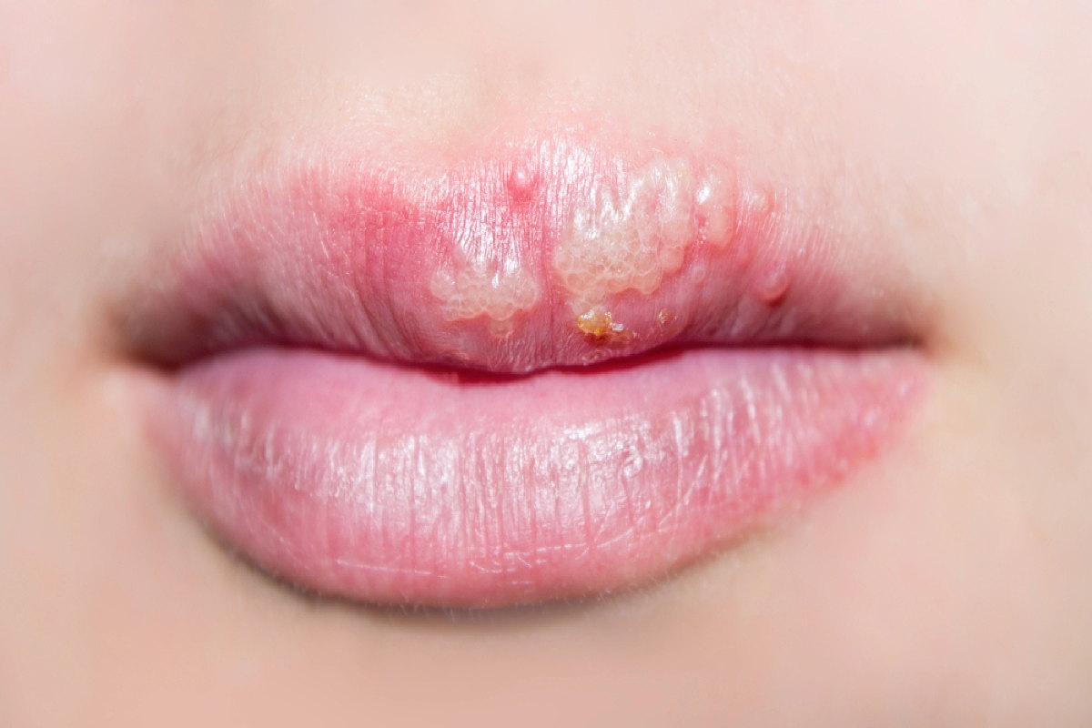 Was hilft gegen Herpes?