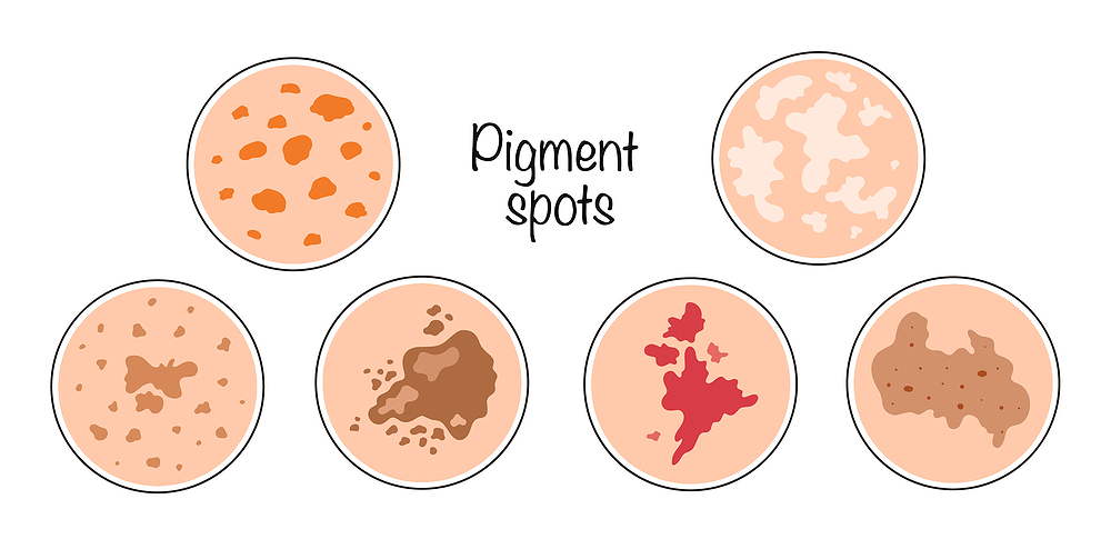 Qu'est-ce qui aide à lutter contre les taches de pigmentation ? 2 pigmente haut