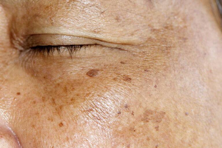 Qu’est-ce qui aide à lutter contre les taches de pigmentation ?