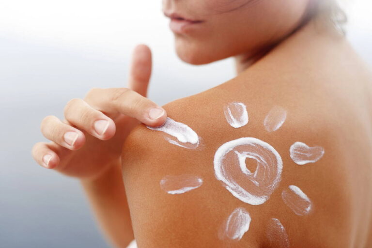 Was hilft gegen Sonnenbrand? Die besten Mittel