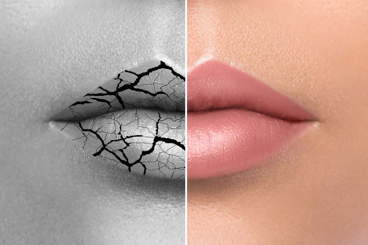 Was hilft gegen trockene Lippen?